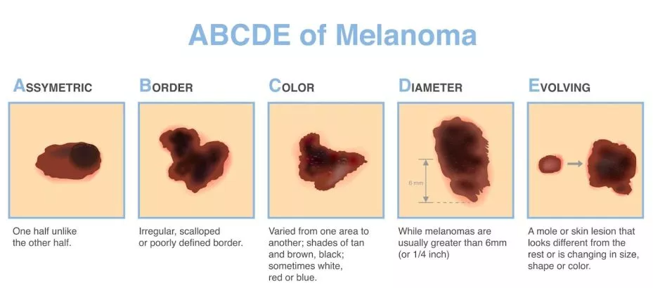 ABCDE Skin Cancer Detection Guide - Asymmetry, Border, Color, Diameter, Evolving